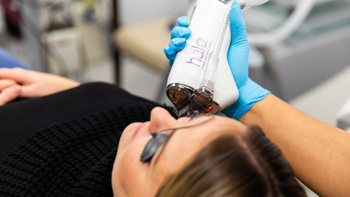 HALO laser resurfacing treatment in Sarasota