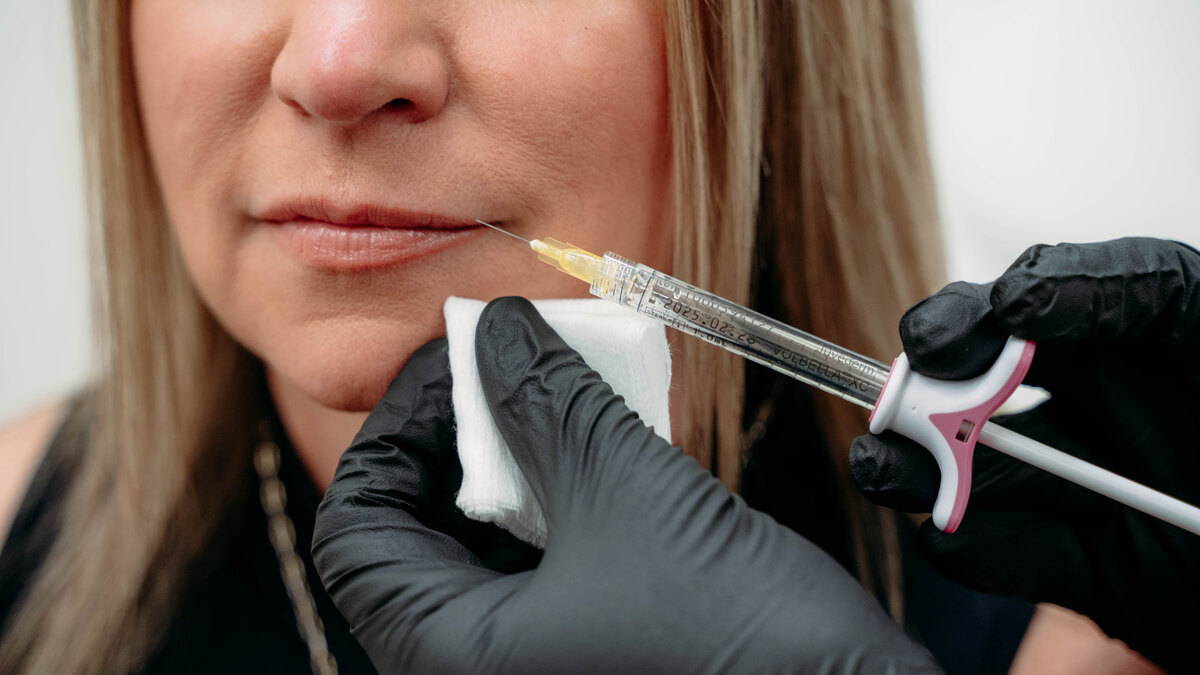 Natural lip filler treatment in Sarasota