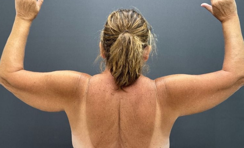 Arm Lift Before & After Image