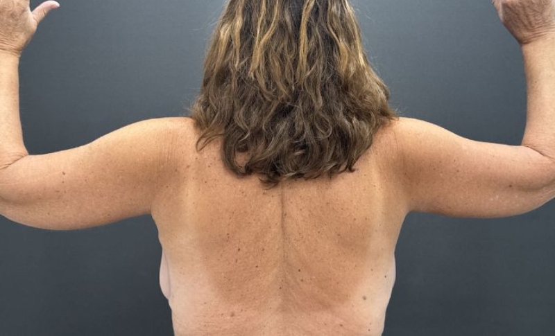 Arm Lift Before & After Image