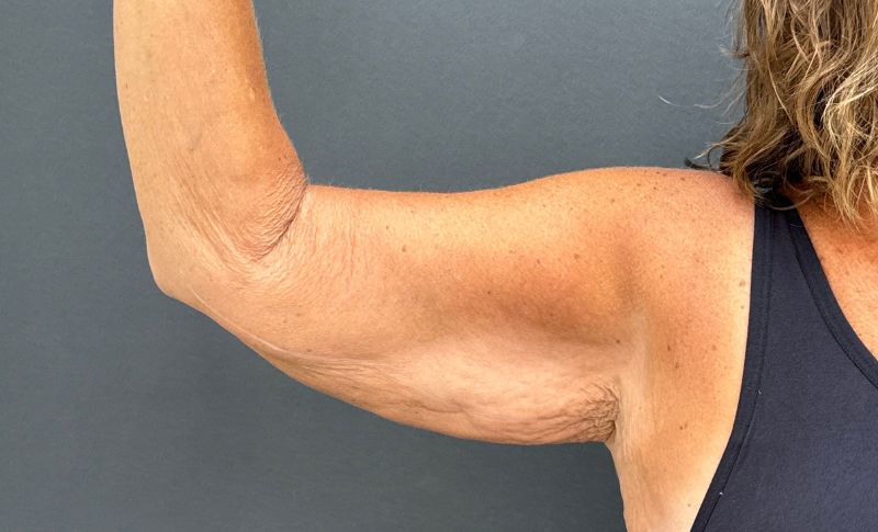 Arm Lift Before & After Image