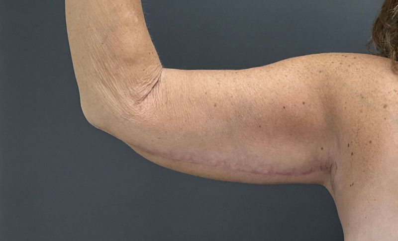 Arm Lift Before & After Image