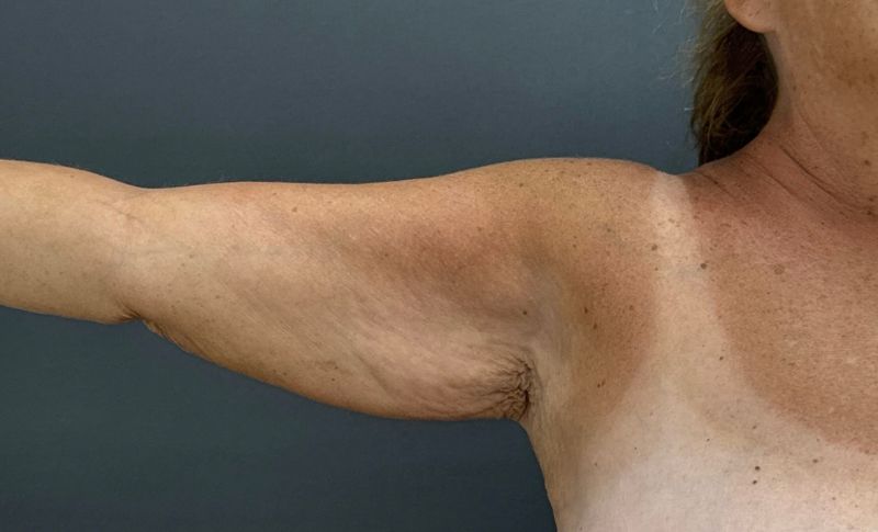 Arm Lift Before & After Image