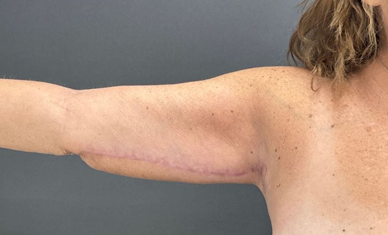 Arm Lift Before & After Image
