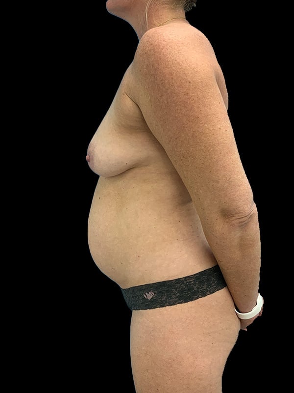 Mommy Makeover Before & After Image