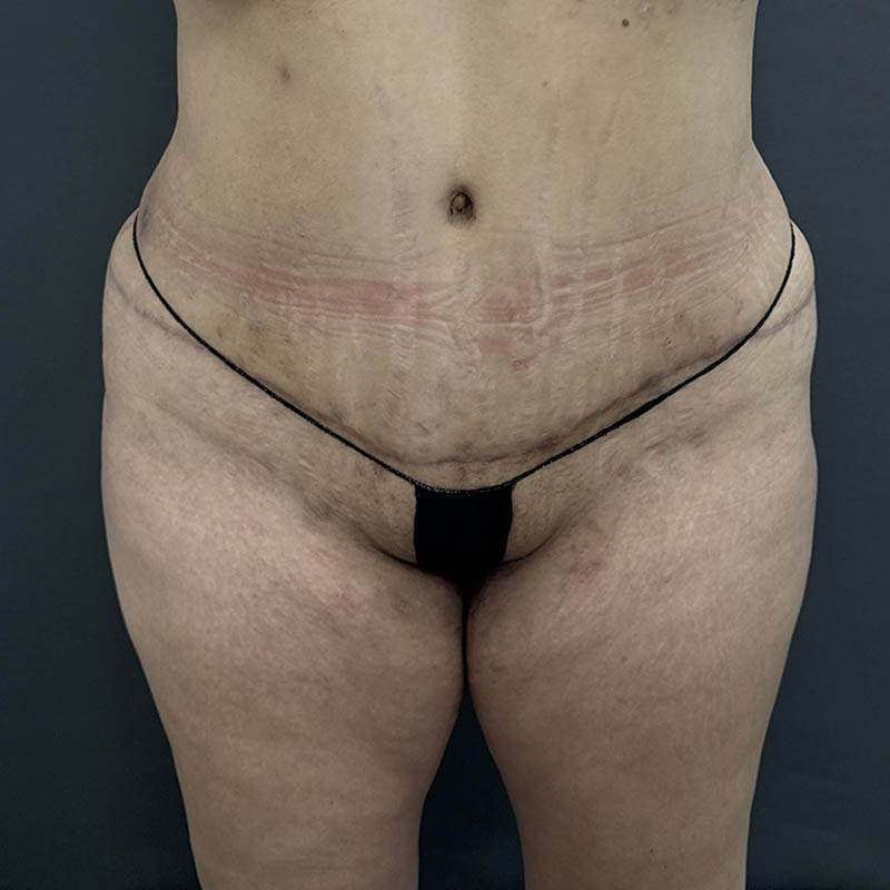 Tummy Tuck Before & After Image