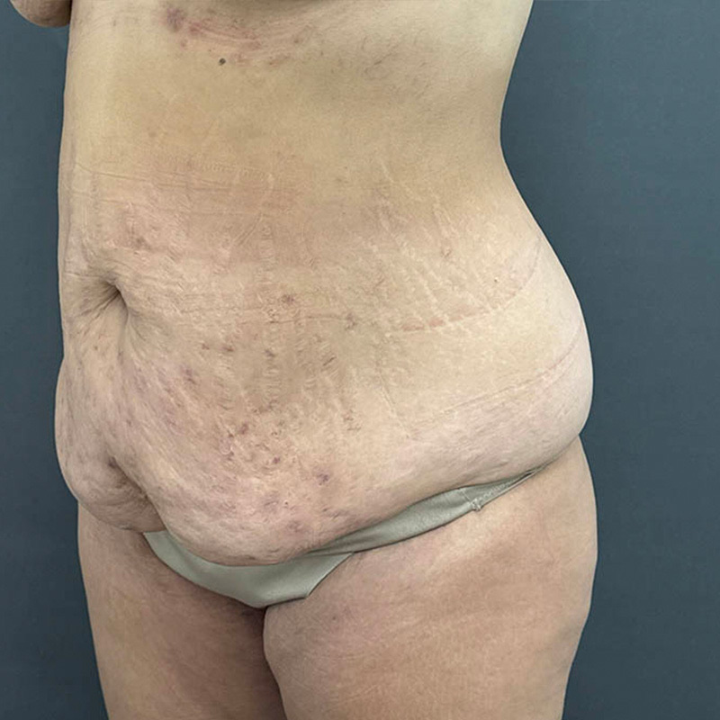 Tummy Tuck Before & After Image