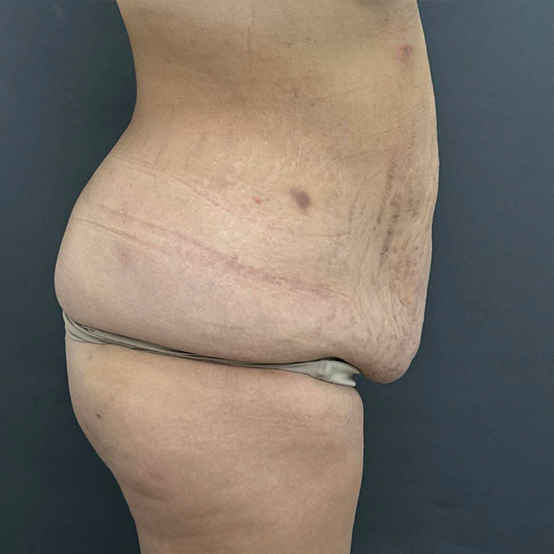 Tummy Tuck Before & After Image