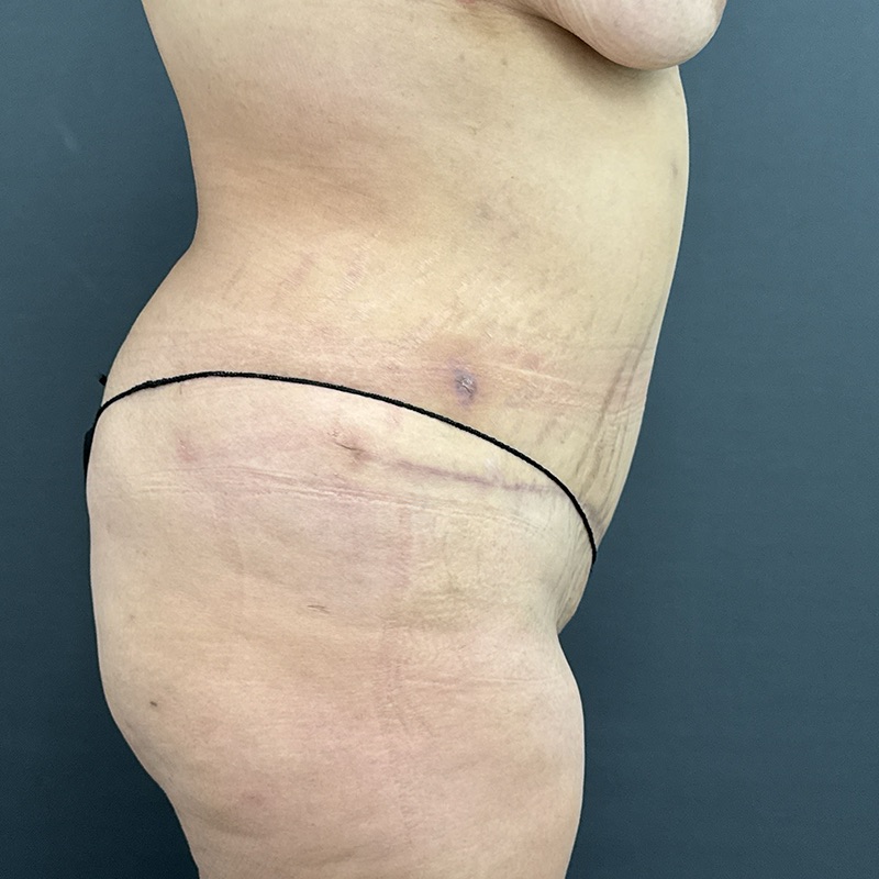 Tummy Tuck Before & After Image
