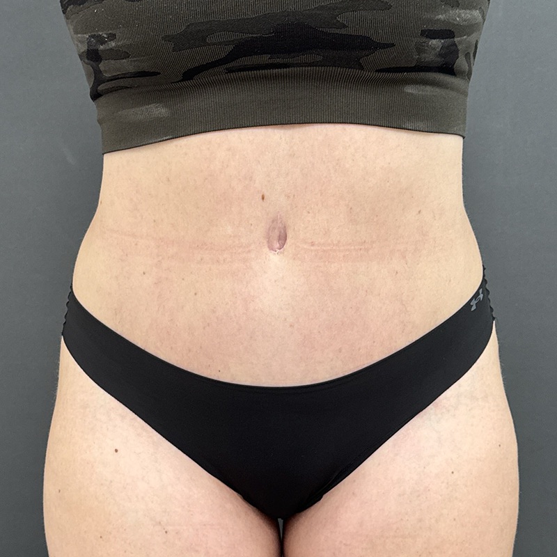 Tummy Tuck Before & After Image