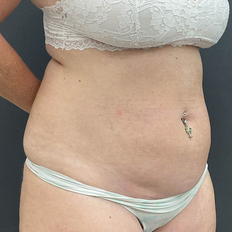 Tummy Tuck Before & After Image