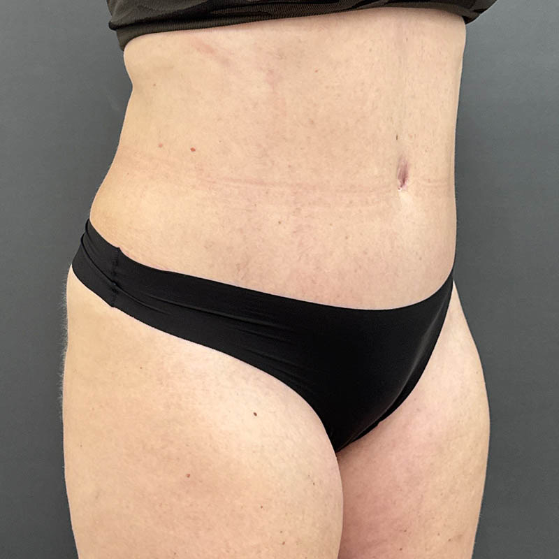 Tummy Tuck Before & After Image