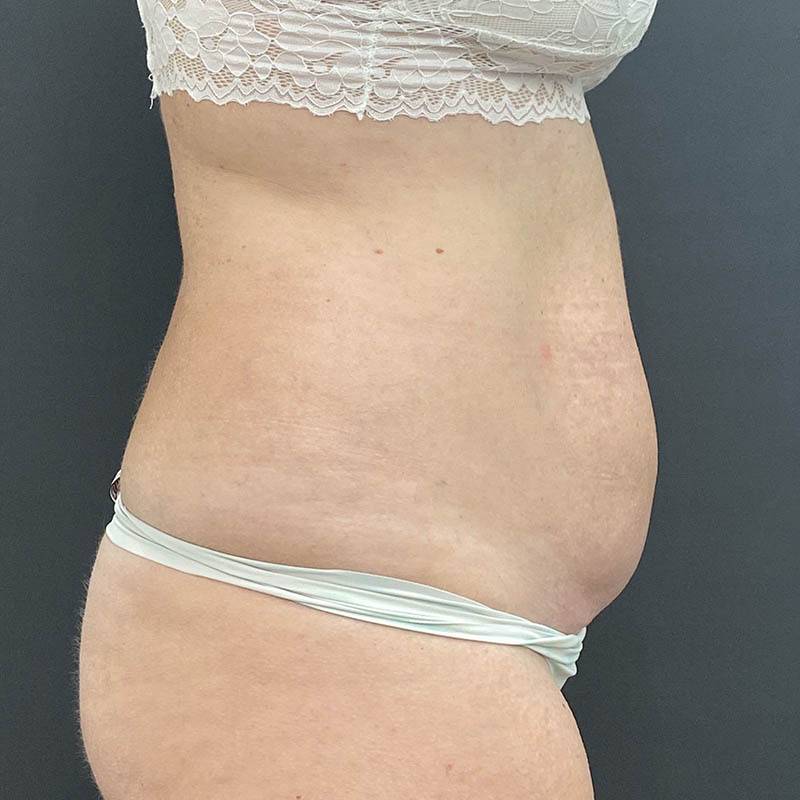 Tummy Tuck Before & After Image