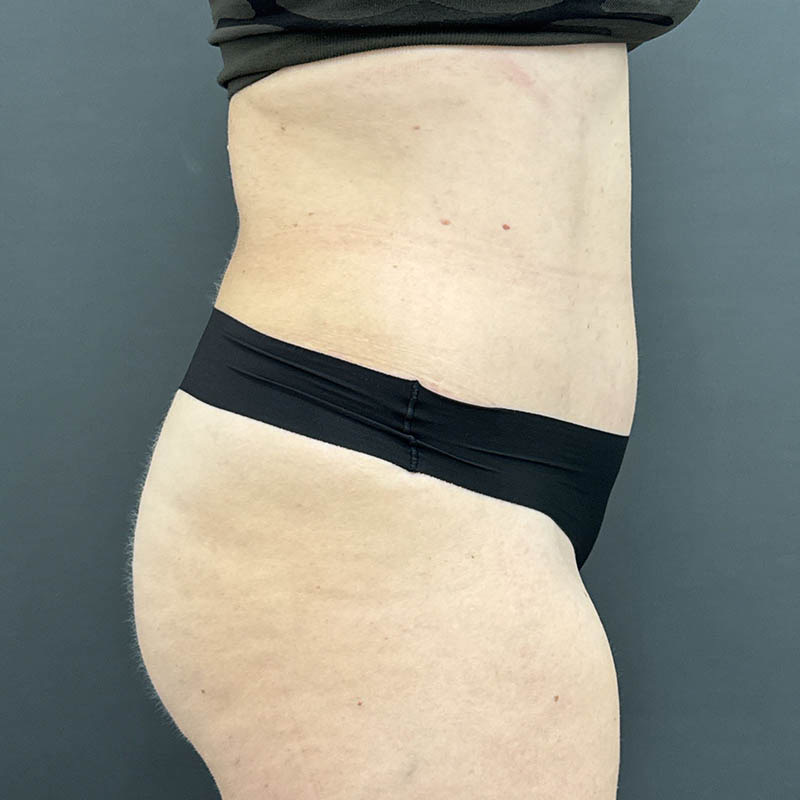 Tummy Tuck Before & After Image