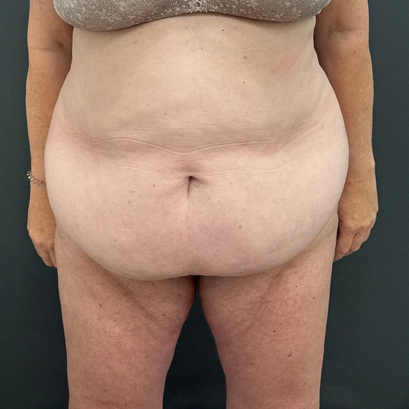 Tummy Tuck Before & After Image
