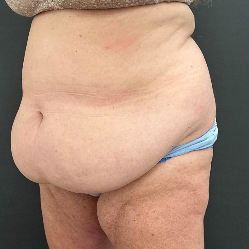 Tummy Tuck Before & After Image