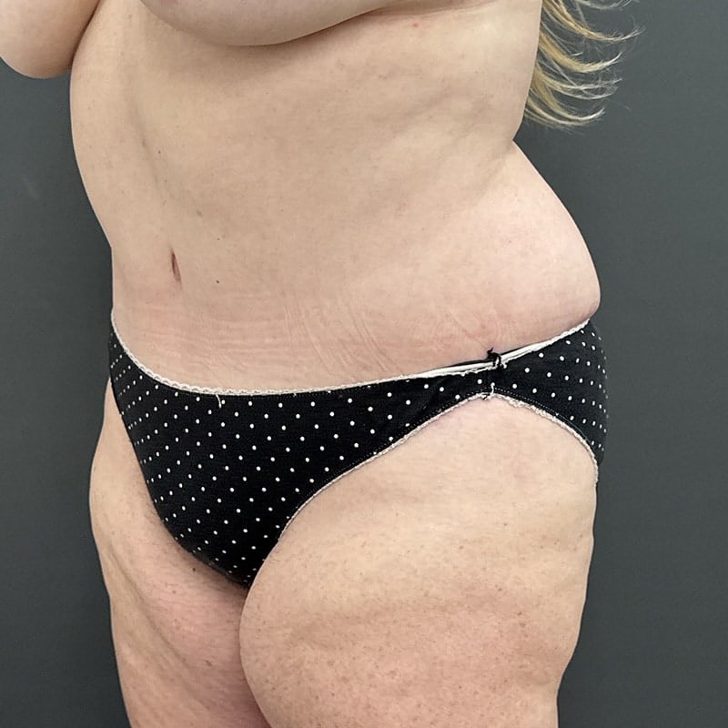 Tummy Tuck Before & After Image