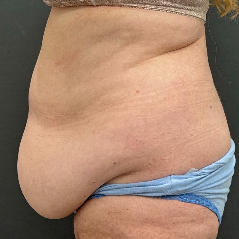 Tummy Tuck Before & After Image