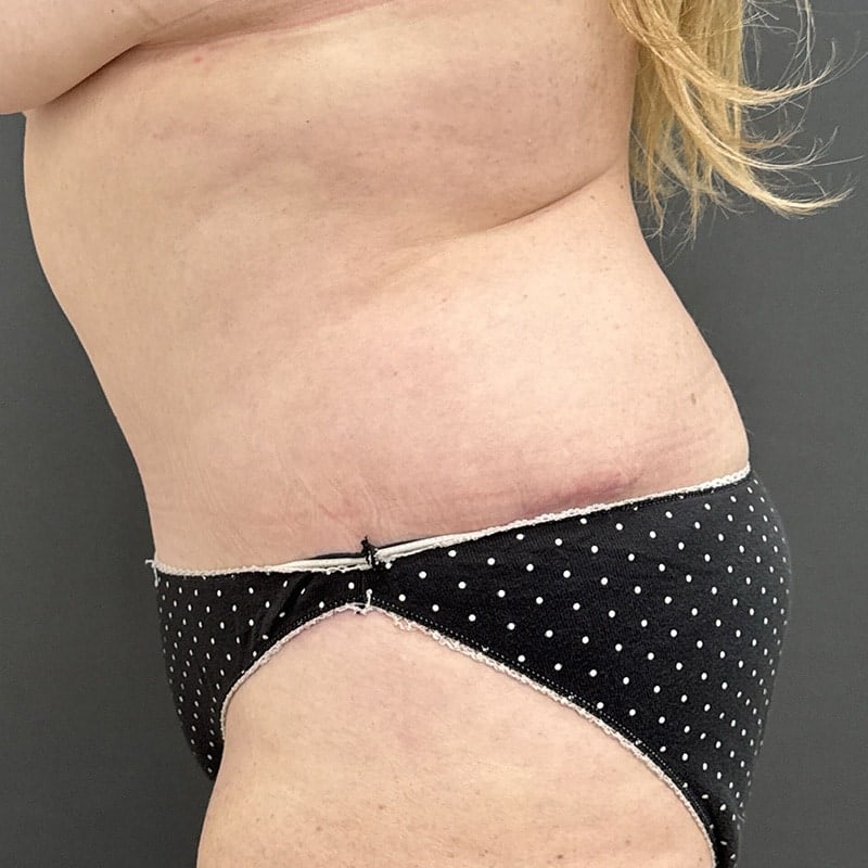Tummy Tuck Before & After Image