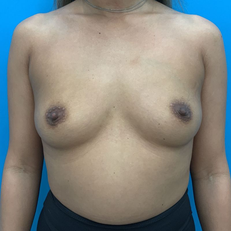 Breast Augmentation Before & After Image