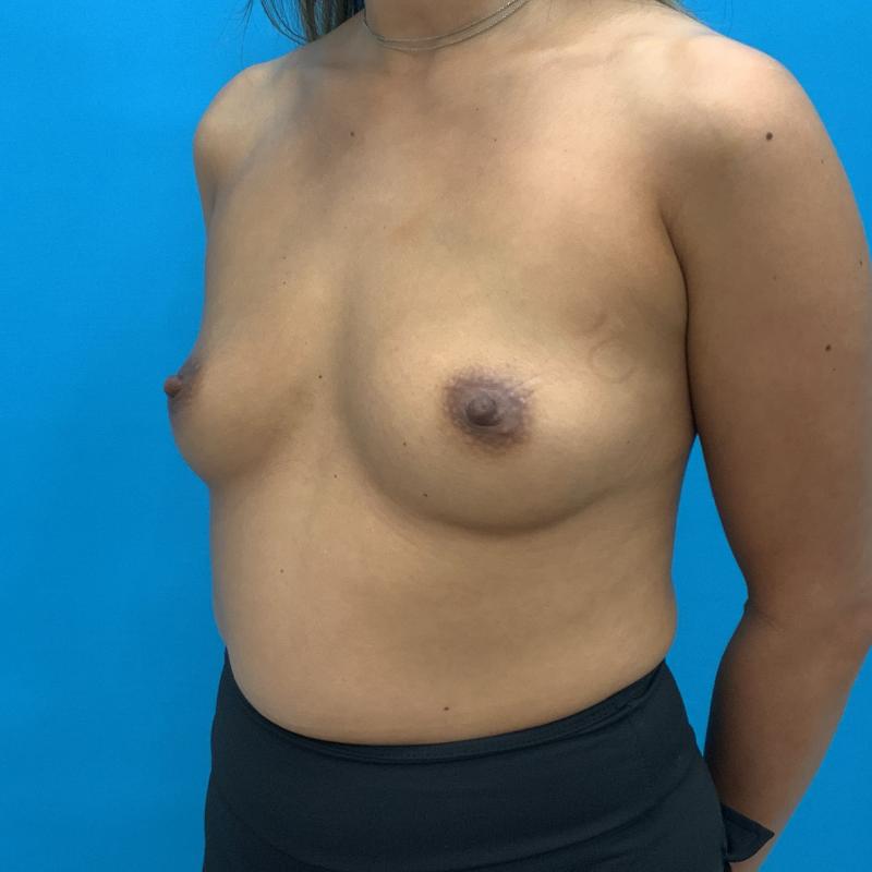 Breast Augmentation Before & After Image