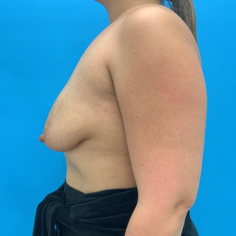 Breast Augmentation Before & After Image