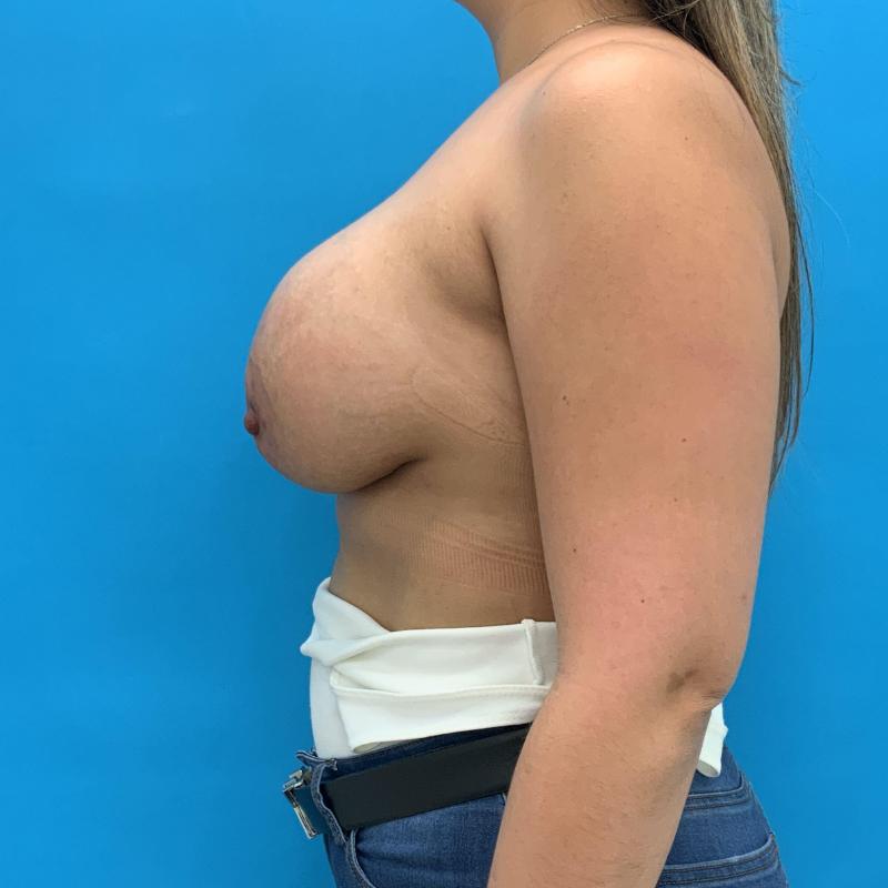 Breast Augmentation Before & After Image