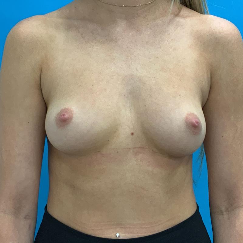 Breast Augmentation Before & After Image
