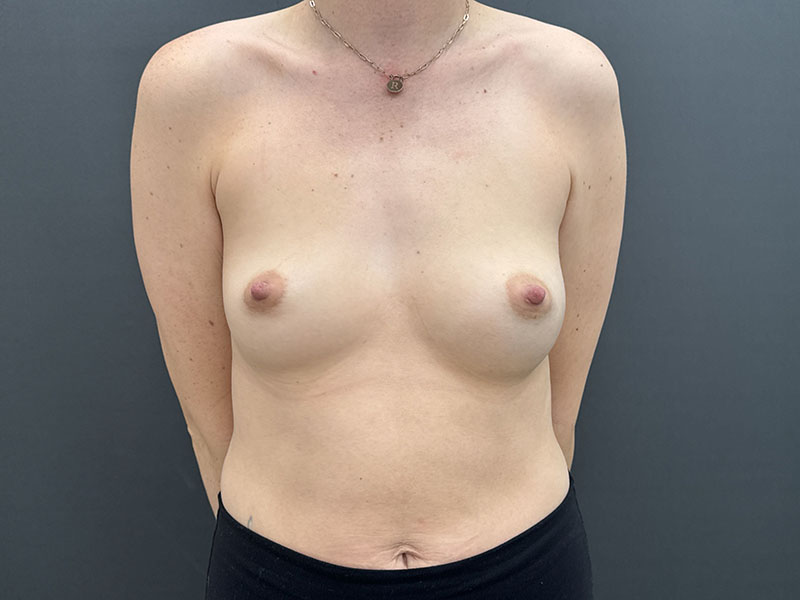Breast Augmentation Before & After Image