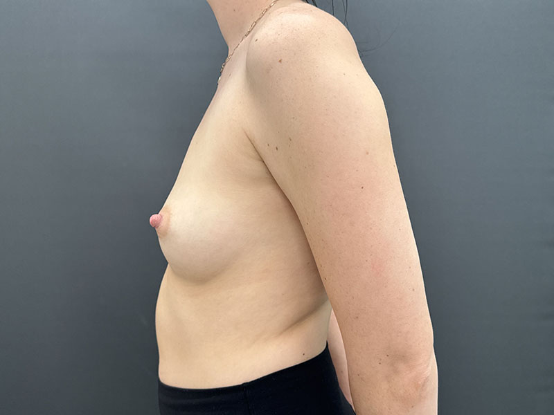 Breast Augmentation Before & After Image