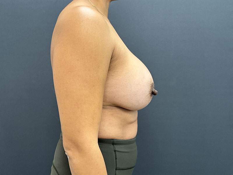 Breast Augmentation Before & After Image