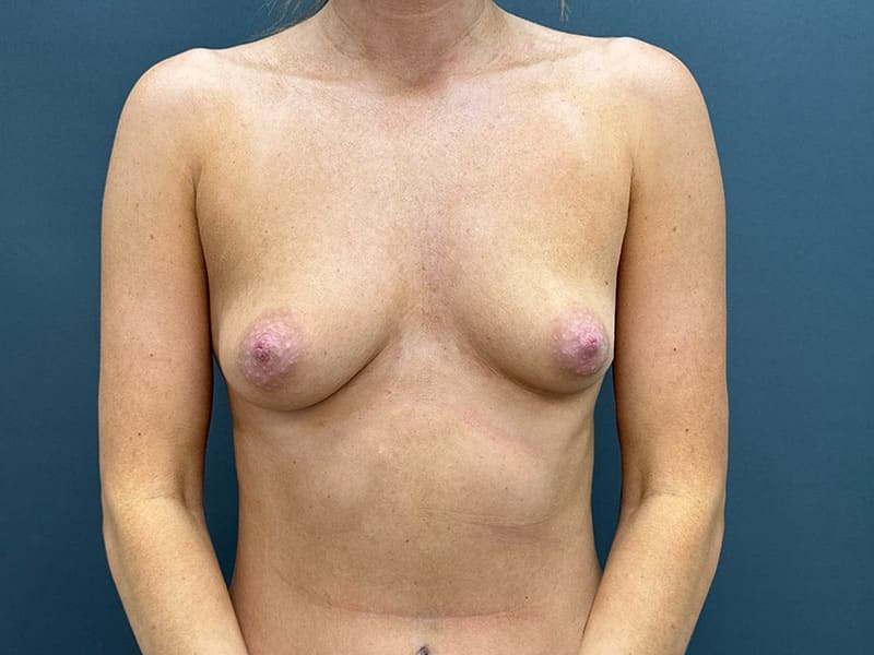 Breast Augmentation Before & After Image