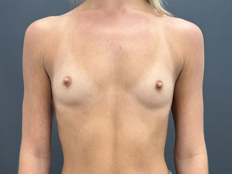 Breast Augmentation Before & After Image