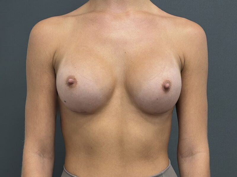 Breast Augmentation Before & After Image