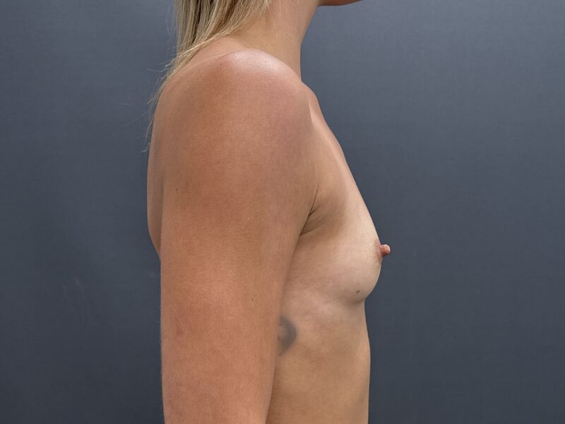 Breast Augmentation Before & After Image