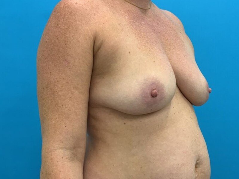 Breast Augmentation Before & After Image