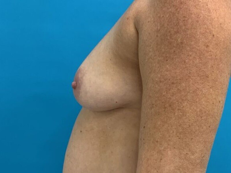 Breast Augmentation Before & After Image