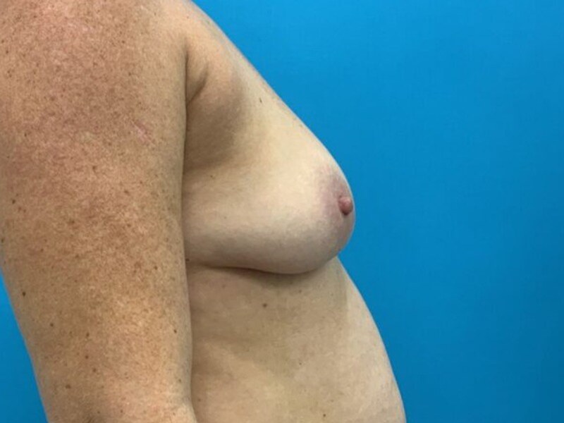 Breast Augmentation Before & After Image
