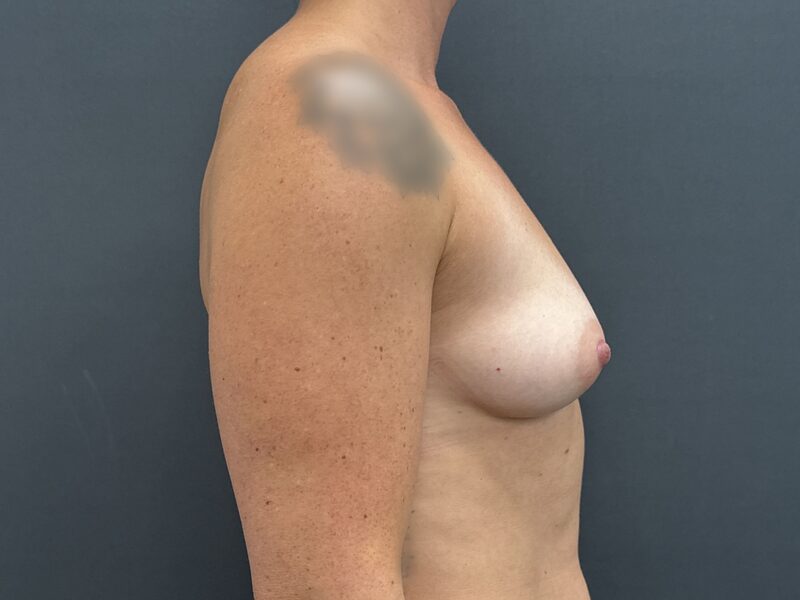 Breast Augmentation Before & After Image
