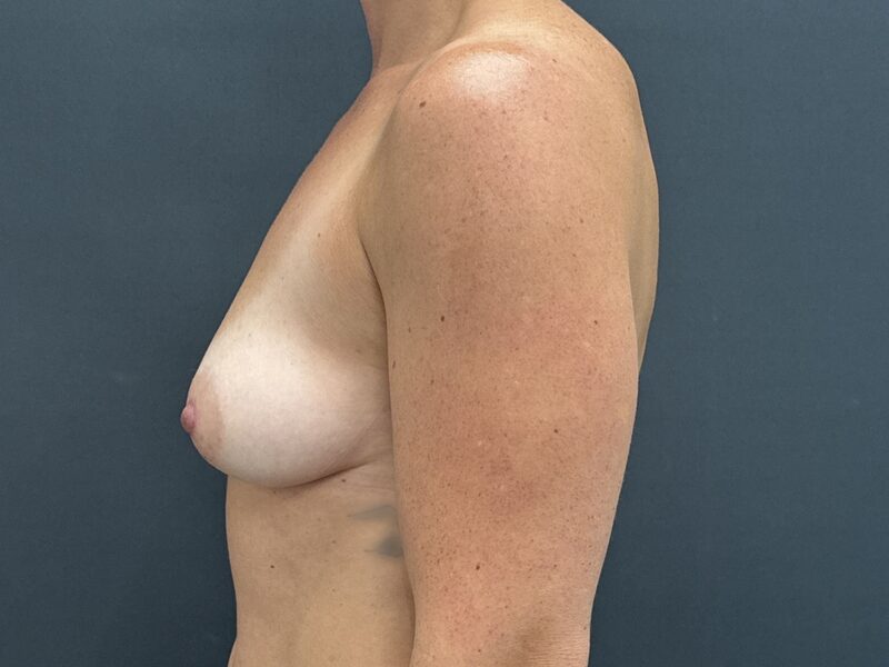 Breast Augmentation Before & After Image