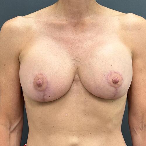 Breast Implant Exchange + Lift Before & After Image