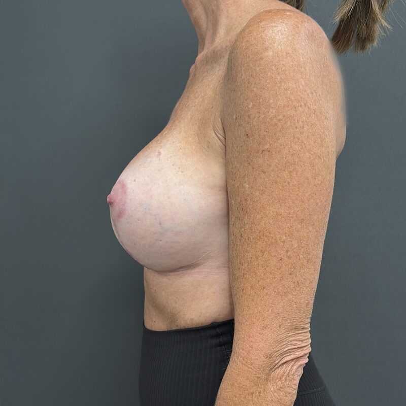 Breast Implant Exchange + Lift Before & After Image
