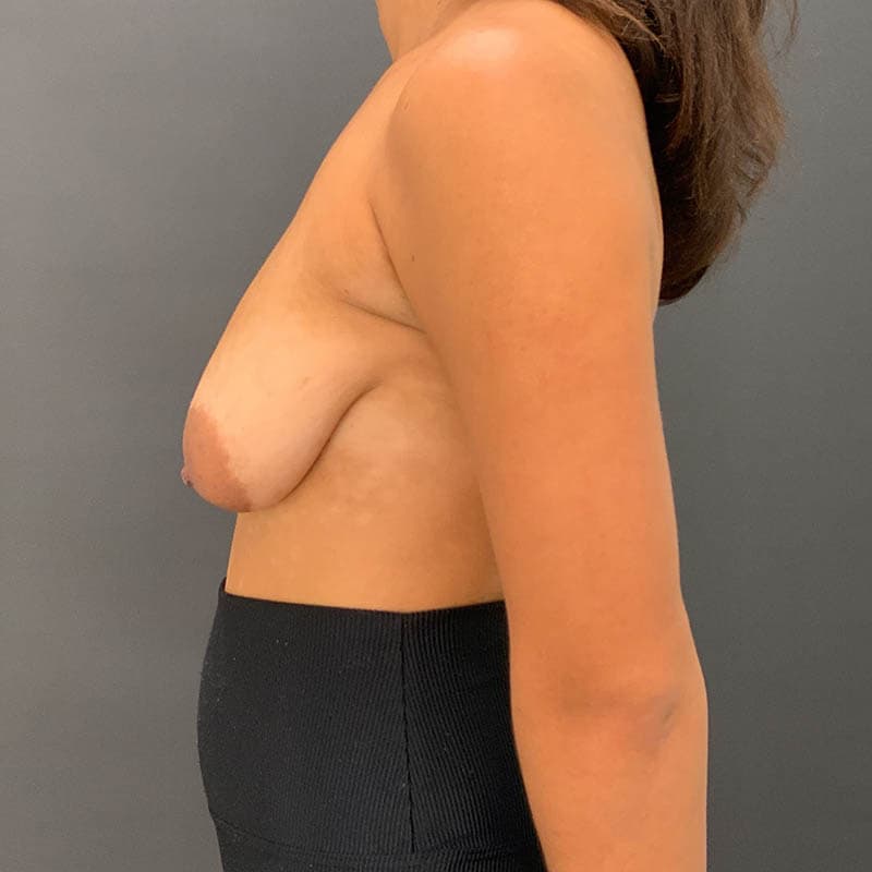 Breast Lift with Augmentation Before & After Image