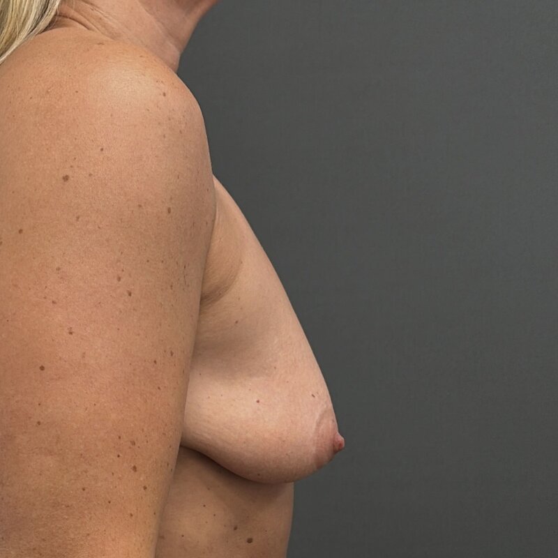 Breast Augmentation + Lift Before & After Image