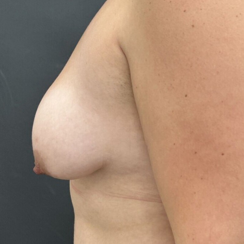 Breast Augmentation + Lift Before & After Image