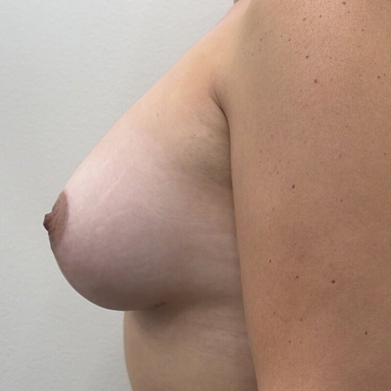 Breast Augmentation + Lift Before & After Image
