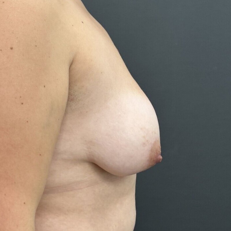 Breast Augmentation + Lift Before & After Image
