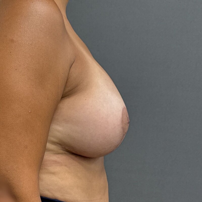 Breast Augmentation + Lift Before & After Image