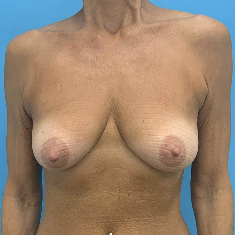 Breast Lift Before & After Image
