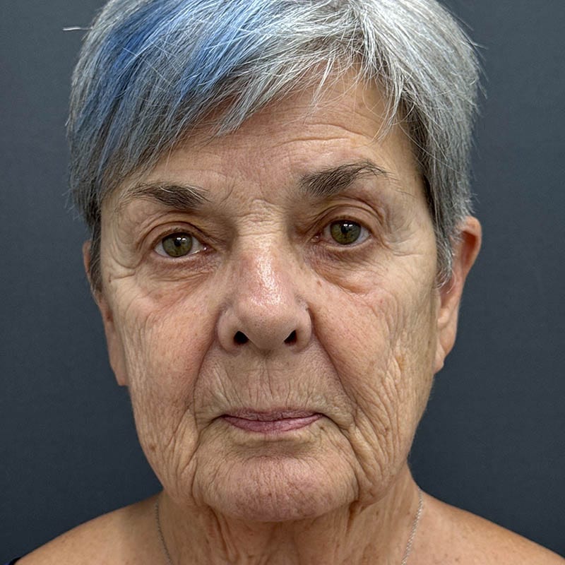 Facelift Before & After Image